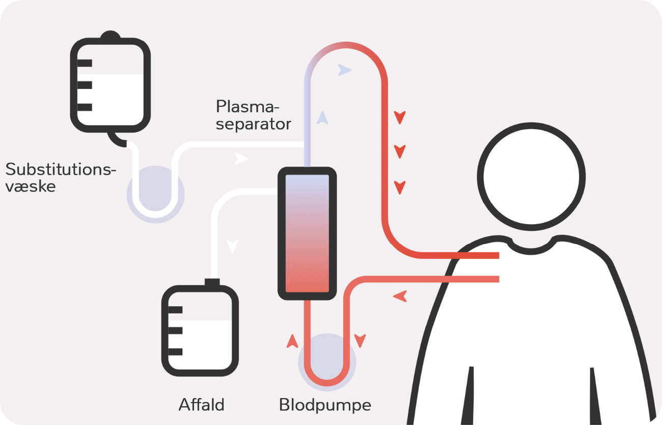 Illustration af plasma-udskiftning