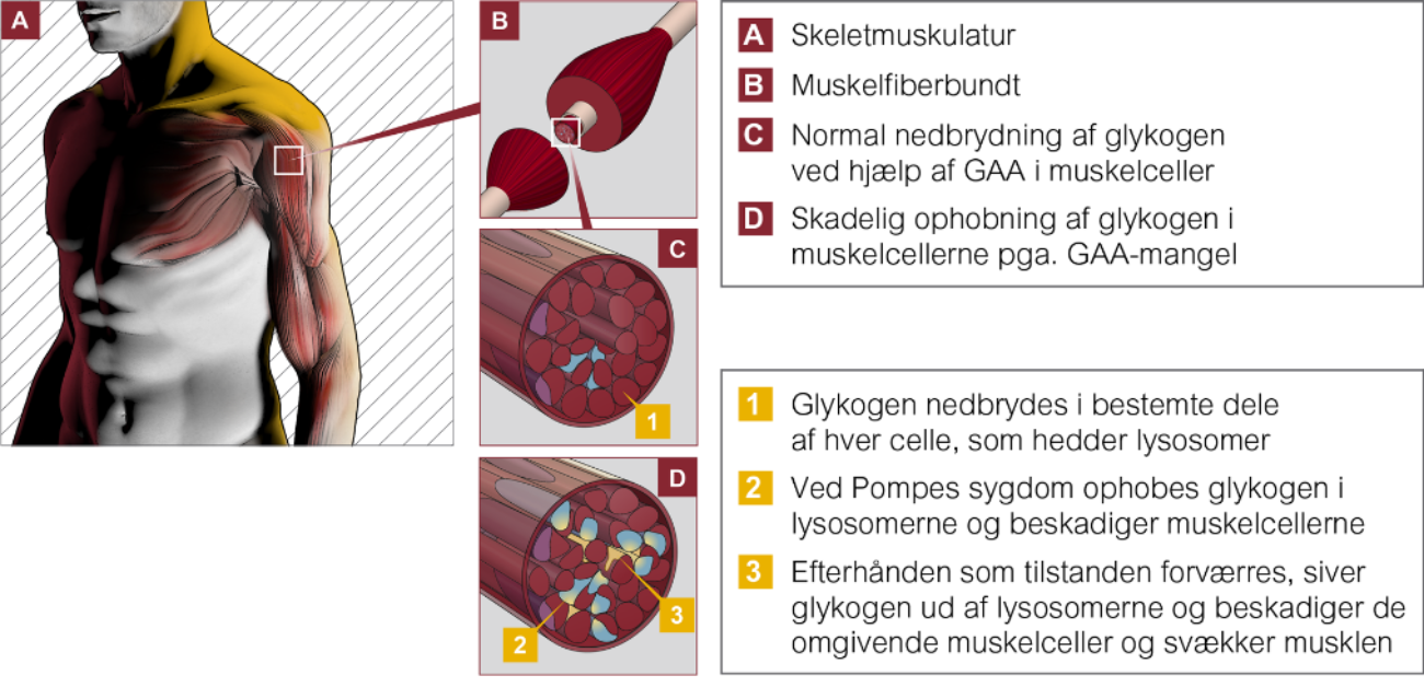 Illustration af Pompes sygdoms effekt på glykogen i cellerne